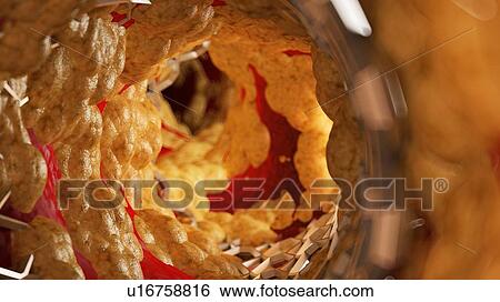 Stock Photograph - Illustration of a stent inside of a fatty artery.. Fotosearch