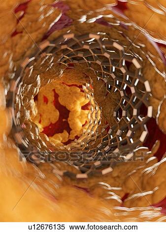 Illustration of a stent inside of a fatty artery. View Large Photo Image Stock Photography - Illustration of a stent inside of a fatty artery.. Fotosearch