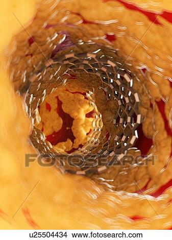 Illustration of a stent inside of an artery. View Large Photo Image Picture - Illustration of a stent inside of an artery.. Fotosearch