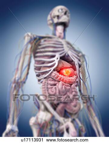 Stock Image - Illustration of a stomach tumour.. Fotosearch
