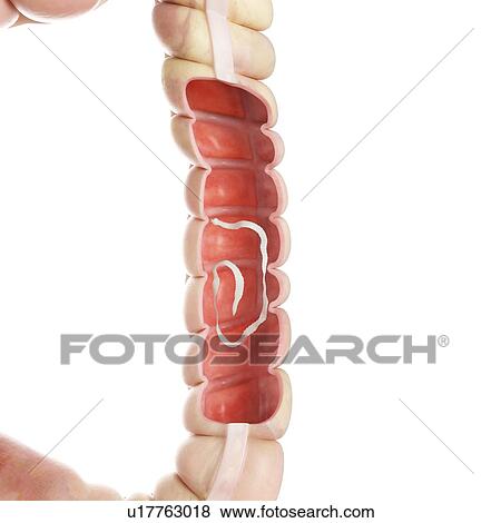 Stock Photo - Illustration of a tapeworm in the large intestine.. Fotosearch