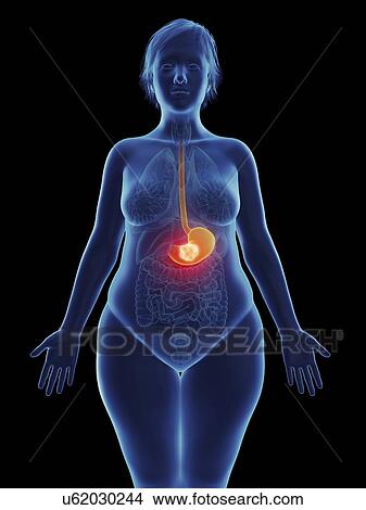 Picture - Illustration of a tumour in a woman's stomach.. Fotosearch