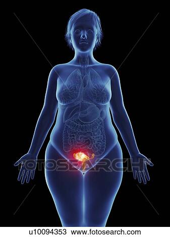 Stock Image - Illustration of a tumour in a woman's uterus.. Fotosearch