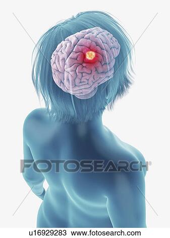 Stock Image - Illustration of a tumour in a woman's brain.. Fotosearch