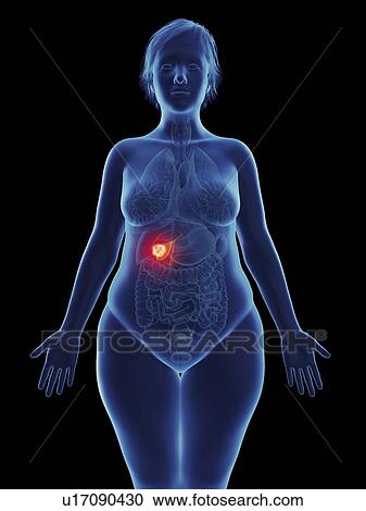 Stock Image - Illustration of a tumour in a woman's gallbladder.. Fotosearch