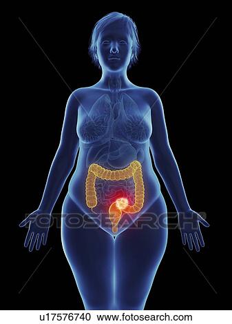 Stock Image - Illustration of a tumour in a woman's rectum.. Fotosearch