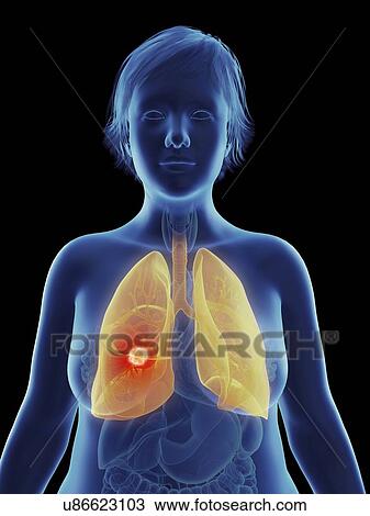 Stock Image - Illustration of a tumour in a woman's lung.. Fotosearch