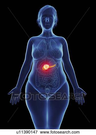 Stock Photo - Illustration of a tumour in a woman's pancreas.. Fotosearch