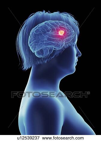 Illustration of a tumour in a woman's brain. View Large Photo Image Stock Photo - Illustration of a tumour in a woman's brain.. Fotosearch