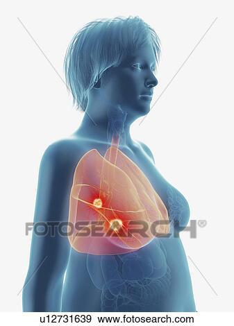 Stock Photo - Illustration of a tumour in a woman's lung.. Fotosearch