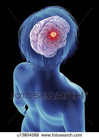 Stock Photo - Illustration of a tumour in a woman's brain.. Fotosearch