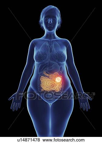 Stock Photo - Illustration of a tumour in a woman's small intestine.. Fotosearch