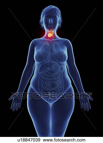 Illustration of a tumour in a woman's larynx. View Large Photo Image Stock Photo - Illustration of a tumour in a woman's larynx.. Fotosearch
