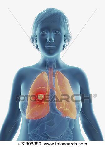 Stock Photo - Illustration of a tumour in a woman's lung.. Fotosearch