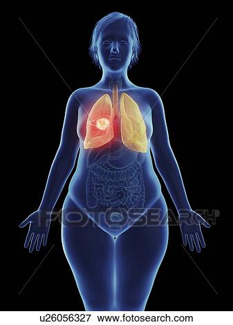 Stock Photo - Illustration of a tumour in a woman's lung.. Fotosearch