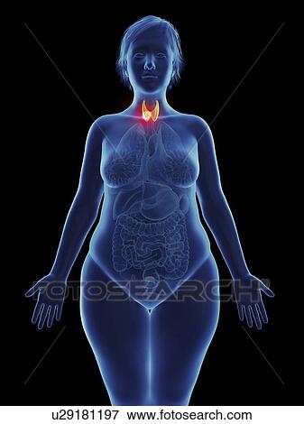 Illustration of a tumour in a woman's thyroid gland. View Large Photo Image Stock Photo - Illustration of a tumour in a woman's thyroid gland.. Fotosearch