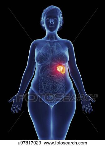 Illustration of a tumour in a woman's spleen. View Large Photo Image Stock Photo - Illustration of a tumour in a woman's spleen.. Fotosearch