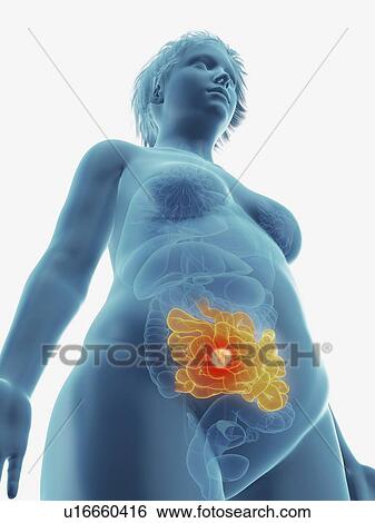 Illustration of a tumour in a woman's small intestine. View Large Photo Image Stock Photograph - Illustration of a tumour in a woman's small intestine.. Fotosearch