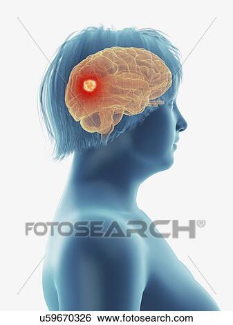 Stock Photograph - Illustration of a tumour in a woman's brain.. Fotosearch