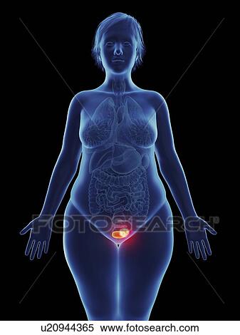 Stock Photography - Illustration of a tumour in a woman's bladder.. Fotosearch