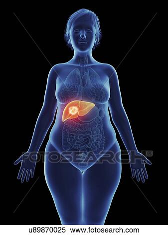 Illustration of a tumour in a woman's tumour. View Large Photo Image Stock Photography - Illustration of a tumour in a woman's tumour.. Fotosearch