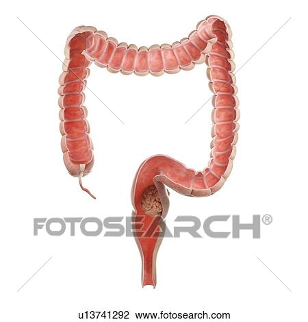 Stock Image - Illustration of a tumour in the rectum.. Fotosearch