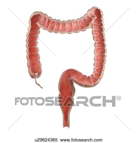 Illustration of a tumour in the rectum. View Large Photo Image Stock Photography - Illustration of a tumour in the rectum.. Fotosearch