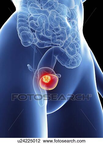Illustration of a woman's bladder cancer. View Large Photo Image Stock Image - Illustration of a woman's bladder cancer.. Fotosearch