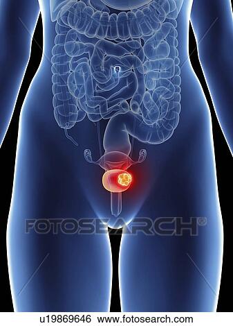 Illustration of a woman's bladder cancer. View Large Photo Image Stock Photograph - Illustration of a woman's bladder cancer.. Fotosearch
