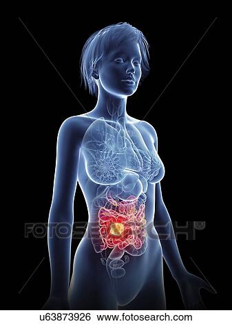 Illustration of a woman's cancer. View Large Photo Image Stock Photograph - Illustration of a woman's cancer.. Fotosearch