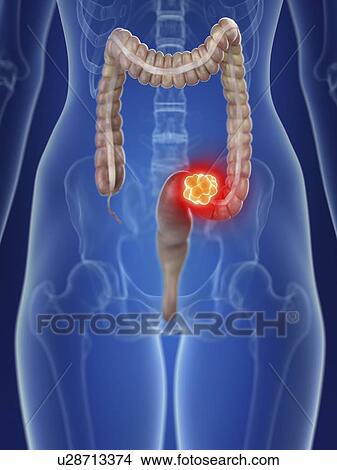 Picture - Illustration of a woman's colon cancer.. Fotosearch
