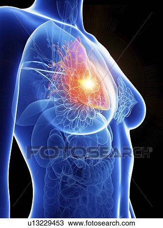 Illustration of a woman's inflamed heart. View Large Photo Image Stock Image - Illustration of a woman's inflamed heart.. Fotosearch