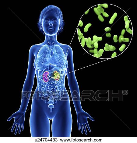 Stock Image - Illustration of a woman's kidney infection.. Fotosearch