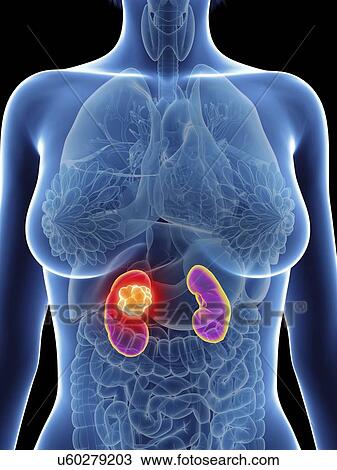 Stock Image - Illustration of a woman's kidneys cancer.. Fotosearch