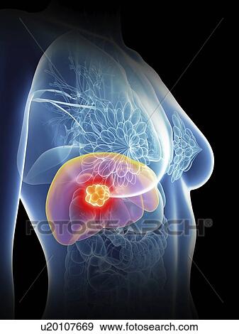 Illustration of a woman's liver cancer. View Large Photo Image Stock Photo - Illustration of a woman's liver cancer.. Fotosearch