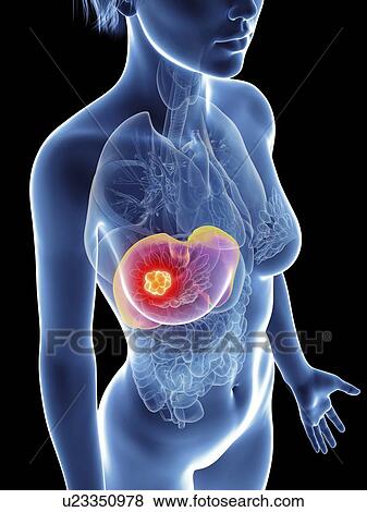 Illustration of a woman's liver cancer. View Large Photo Image Stock Photo - Illustration of a woman's liver cancer.. Fotosearch