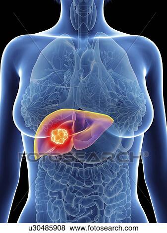 Illustration of a woman's liver cancer. View Large Photo Image Stock Photo - Illustration of a woman's liver cancer.. Fotosearch