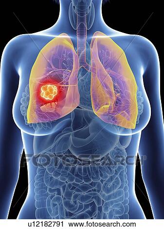 Illustration of a woman's lung cancer. View Large Photo Image Stock Image - Illustration of a woman's lung cancer.. Fotosearch
