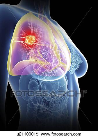 Stock Photography - Illustration of a woman's lung cancer.. Fotosearch