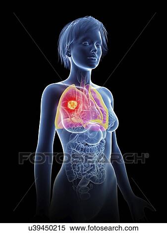 Stock Photography - Illustration of a woman's lung cancer.. Fotosearch