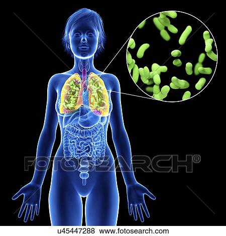 Stock Photo - Illustration of a woman's lung infection.. Fotosearch