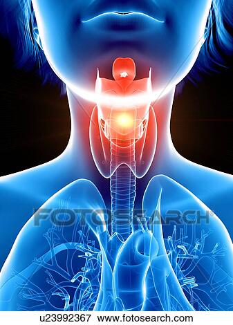 Illustration of a woman's painful throat. View Large Photo Image Stock Photo - Illustration of a woman's painful throat.. Fotosearch