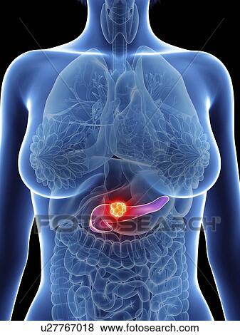 Stock Photo - Illustration of a woman's pancreas cancer.. Fotosearch