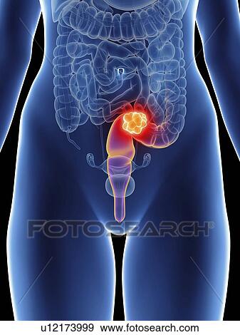 Illustration of a woman's rectum cancer. View Large Photo Image Stock Photo - Illustration of a woman's rectum cancer.. Fotosearch