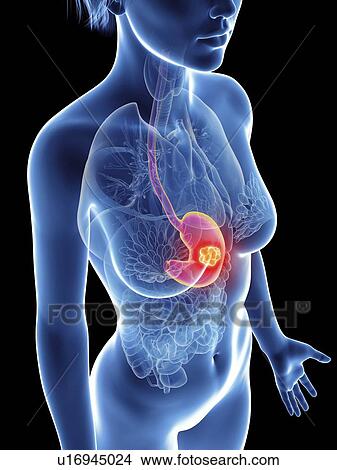 Picture - Illustration of a woman's stomach cancer.. Fotosearch