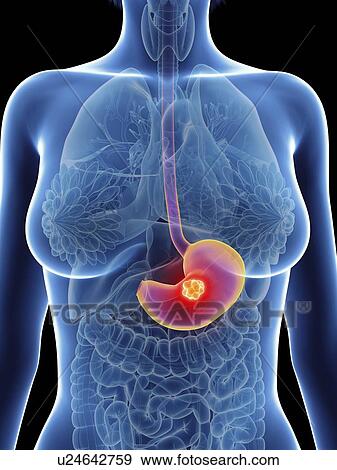 Stock Photo - Illustration of a woman's stomach cancer.. Fotosearch