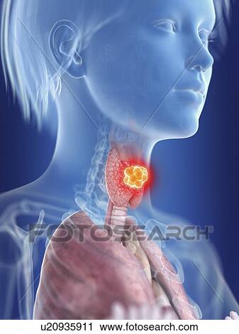 Illustration of a woman's thyroid gland cancer. View Large Photo Image Stock Image - Illustration of a woman's thyroid gland cancer.. Fotosearch