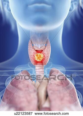 Illustration of a woman's thyroid gland cancer. View Large Photo Image Stock Photo - Illustration of a woman's thyroid gland cancer.. Fotosearch