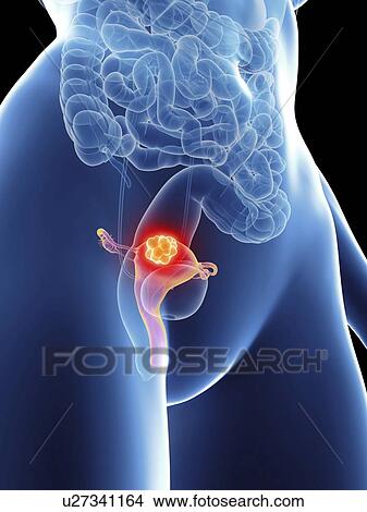 Picture - Illustration of a woman's uterus cancer.. Fotosearch