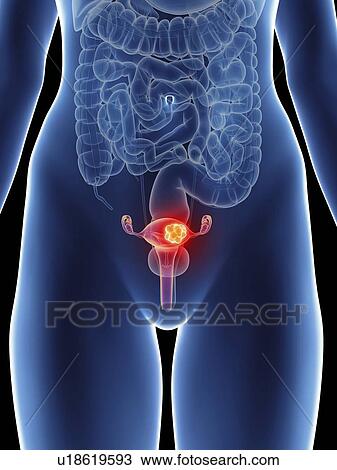 Stock Image - Illustration of a woman's uterus cancer.. Fotosearch